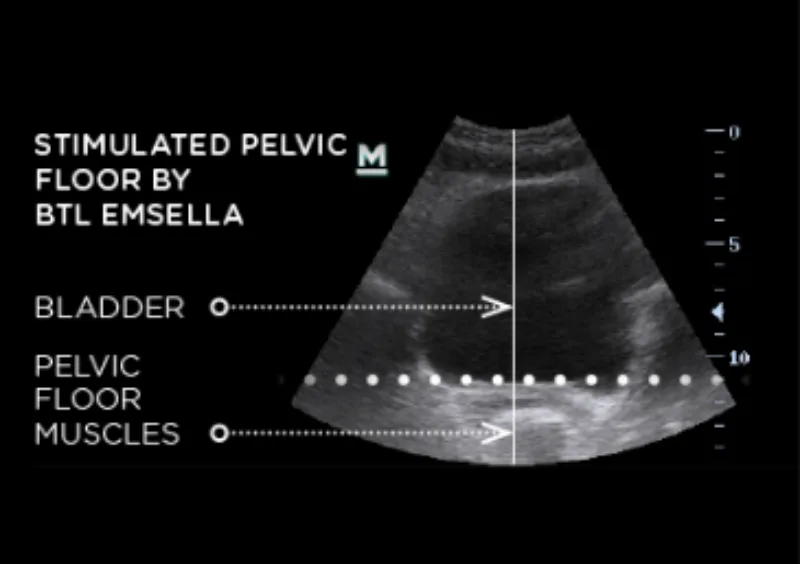 After HIFEM Ultrasound Imaging Ultrasound
