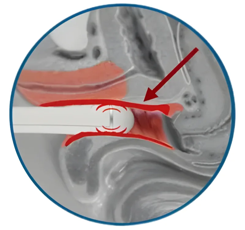 Before Treatment Demo - EMFEMME Vaginal Rejuvenation Treatment
