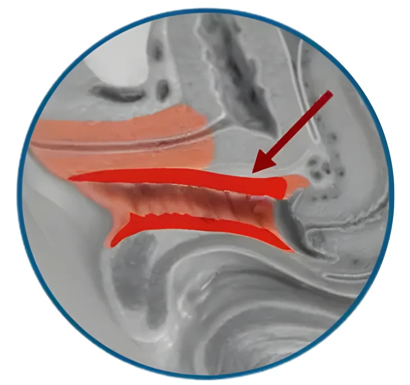 After Treatment Demo - EMFEMME Vaginal Rejuvenation Treatment