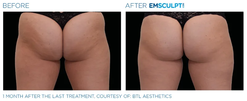 Buttocks - EMSCULPT NEO Treatments - Vigeo care Center & Aesthetics In Algonquin IL