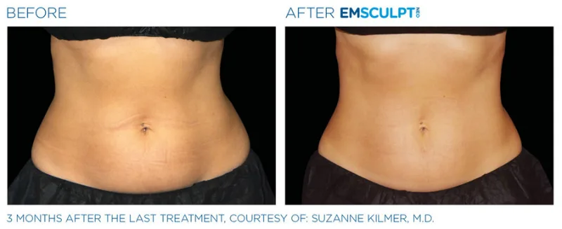 Abdomen - EMSCULPT NEO Treatments - Vigeo care Center & Aesthetics In Algonquin IL