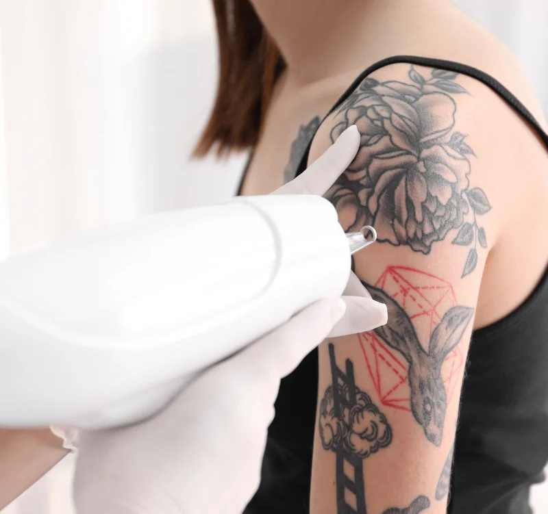 How It Works - Spectrum Laser Tattoo Removal - Vigeo Care Center & Aesthetics In Algonquin IL