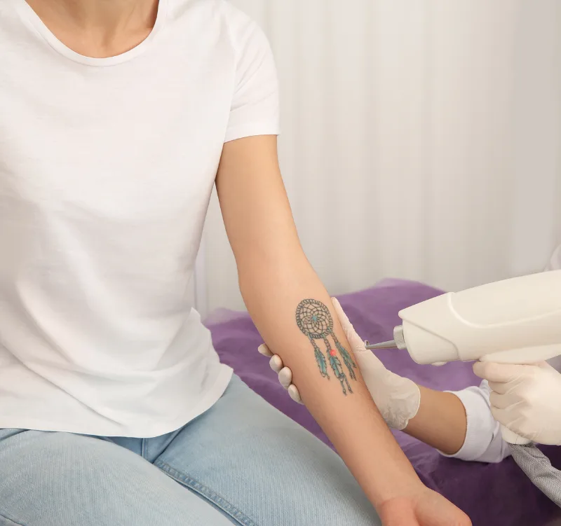 What to expect - Spectrum Laser Tattoo Removal - Vigeo Care Center & Aesthetics In Algonquin IL