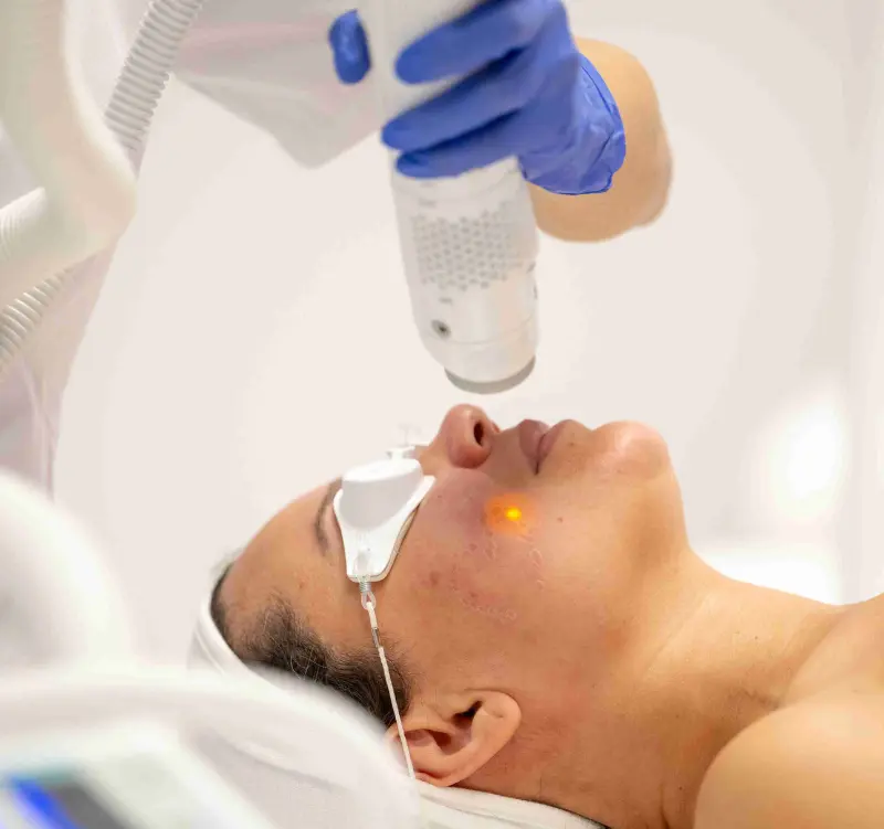 Patient Acne Treatment - Vigeo Care Center & Aesthetics In Algonquin IL