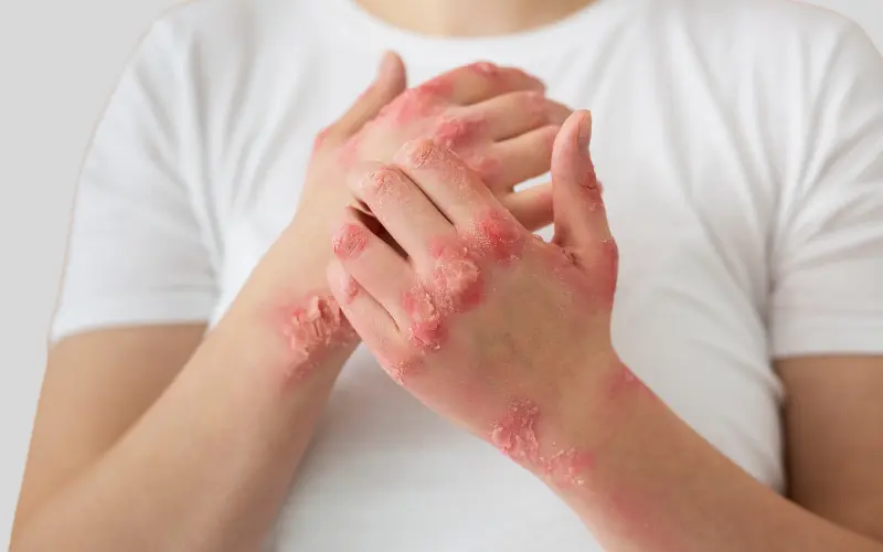 Aerolase Autoimmune & Chronic Skin Disorder Treatments - Vigeo care center & Aesthetics In Algonquin IL