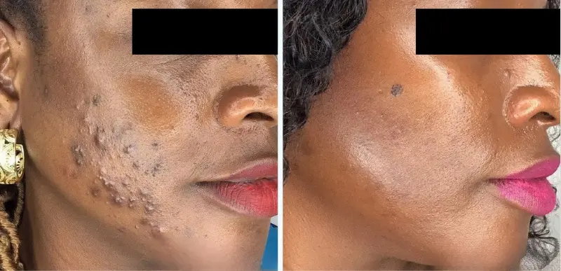 Face Acne Treatment3 - Aerolase Laser Services