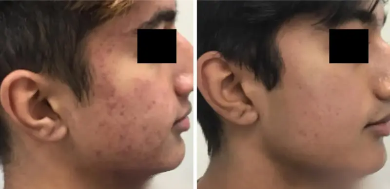 Face Acne Treatment1 - Aerolase Laser Services - Vigeo Care Center & Aesthetics In Algonquin IL