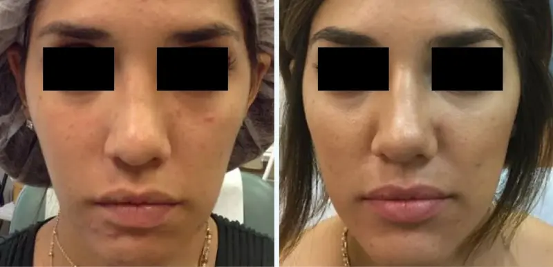 Face Acne Treatment2 - Aerolase Laser Services - Vigeo Care Center & Aesthetics In Algonquin IL