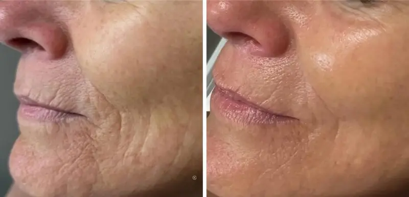 face Anti-Aging & Rejuvenation Treatments - Aerolase Laser Services - Vigeo Care Center & Aesthetics In Algonquin IL