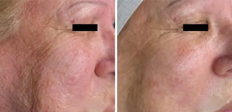 Face Anti-Aging & Rejuvenation1 Treatments - Aerolase Laser Services - Vigeo Care Center & Aesthetics In Algonquin IL