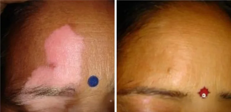 Face - Autoimmune & Chronic Skin Disorder Treatments - Aerolase Laser Services - Vigeo Care Center & Aesthetics In Algonquin IL