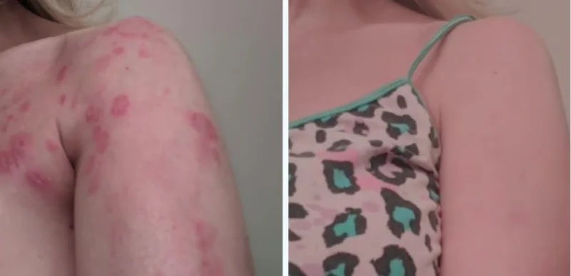 Arms - Autoimmune & Chronic Skin Disorder Treatments - Aerolase Laser Services - Vigeo Care Center & Aesthetics In Algonquin IL