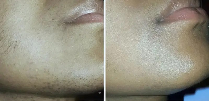 Hair Removal Treatment - Aerolase Laser Services - Vigeo Care Center & Aesthetics In Algonquin IL