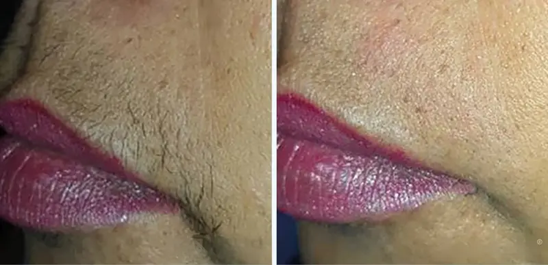 Hair Removal & PFB Treatment - Aerolase Laser Services - Vigeo Care Center & Aesthetics In Algonquin IL