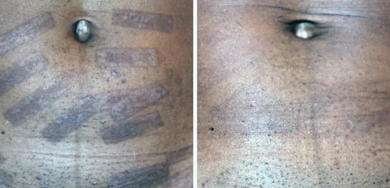 Hyperpigmentation Treatment - Aerolase Laser Services - Vigeo Care Center & Aesthetics In Algonquin IL