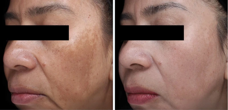 Melasma & Hyperpigmentation Treatments - Aerolase Laser Services - Vigeo Care Center & Aesthetics In Algonquin IL