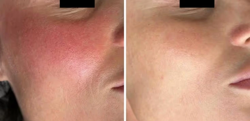 face redness - Rosacea & Inflammatory Skin Conditions Treatment - Aerolase Laser Services - Vigeo Care Center & Aesthetics In Algonquin IL
