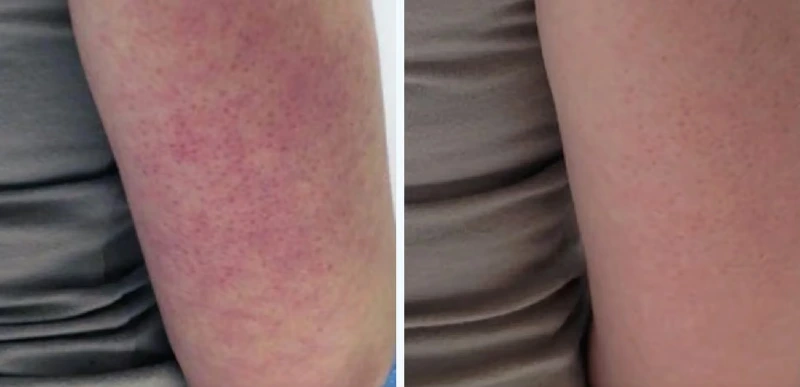 Arms redness - Rosacea & Inflammatory Skin Conditions Treatment - Aerolase Laser Services - Vigeo Care Center & Aesthetics In Algonquin IL