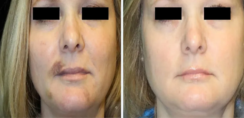 Face Vascular Lesions Treatment1 - Aerolase Laser Services - Vigeo Care Center & Aesthetics In Algonquin IL
