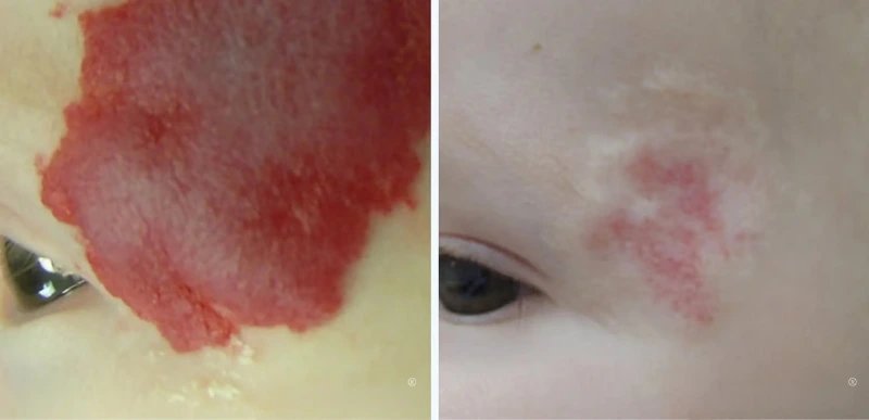 Face Vascular Lesions Treatment - Aerolase Laser Services - Vigeo Care Center & Aesthetics In Algonquin IL