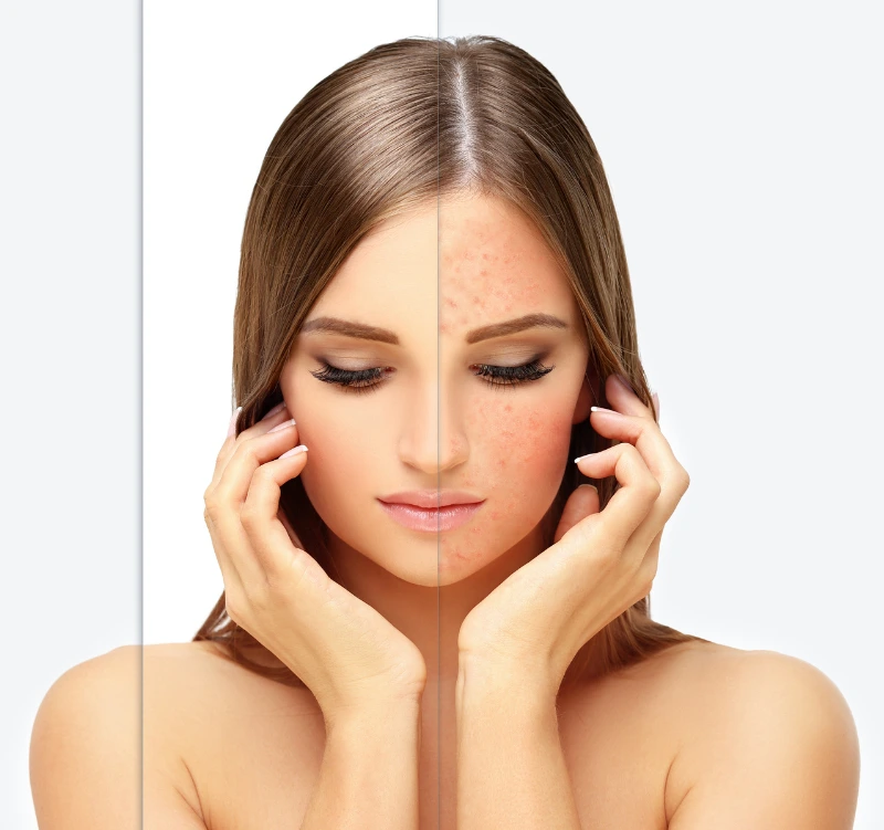 Aerolase Melasma & Hyperpigmentation Treatment - Vigeo Care Center & Aesthetics In Algonquin IL