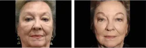 Sagging skin and wrinkles before and after Exion RF Microneedling - Vigeo Care Center & Aesthetics In Algonquin IL