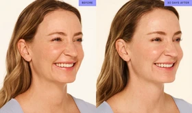 MODERATE TO SEVERE CROW FEET LINES - Neurotoxin Services - Vigeo Care Center & Aesthetics in Algonquin IL